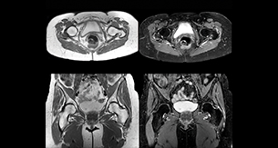 Lefebvre Case Hip MRI thumbnail
